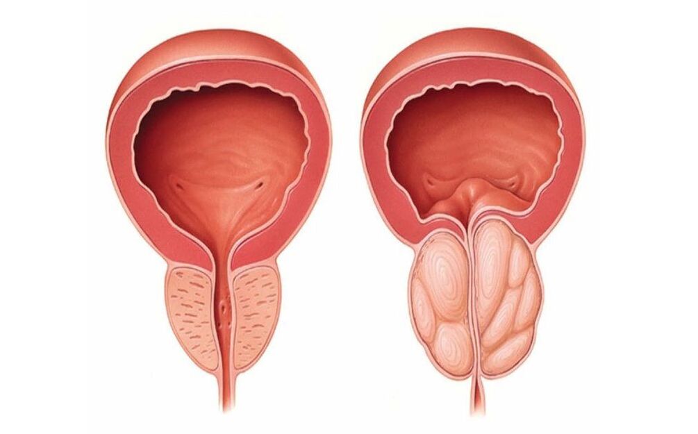 normali ir uždegiminė prostata