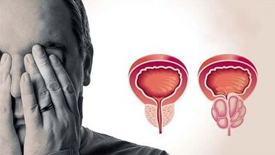 Vyrų prostatito vystymosi priežastys