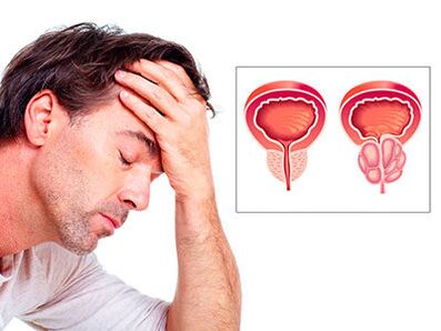 Vyrą nerimauja prostatito simptomai