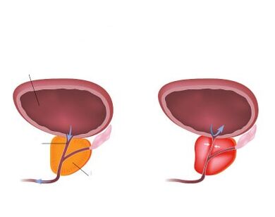 Normalus ir uždegtas prostata